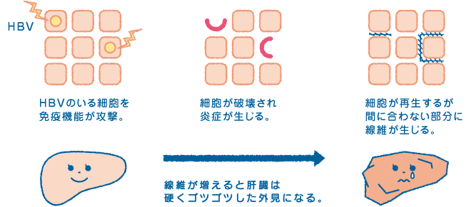 肝硬変への経緯